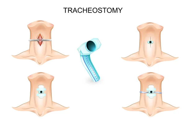 Traqueostomía. tubo de traqueostomía — Vector de stock