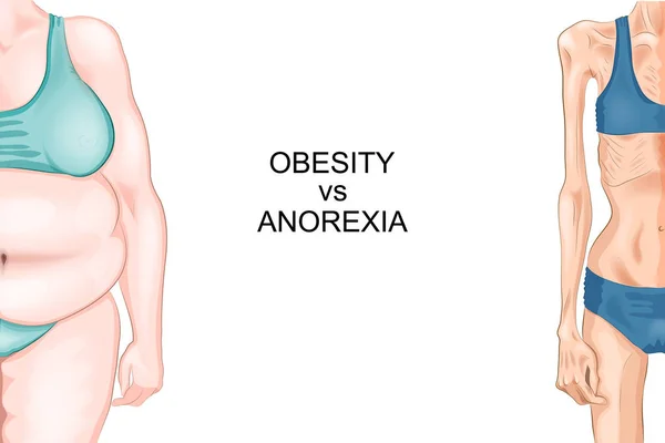 Anorexie et obésité — Image vectorielle