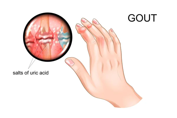 Gout, arthritis of fingers — Stock Vector