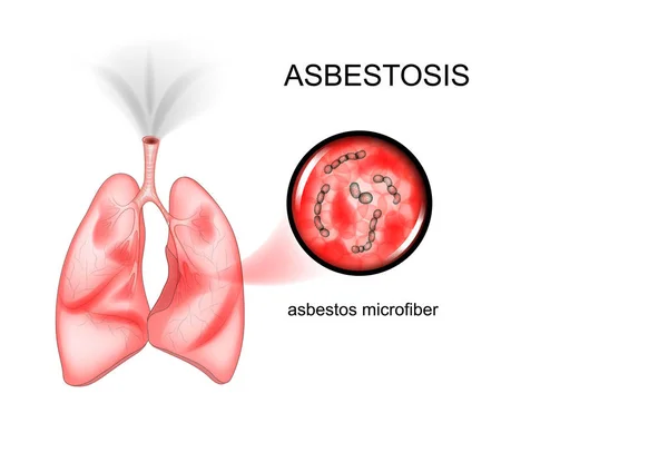 Amianto enfermedad pulmonar — Vector de stock