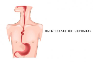 diverticula of the esophagus clipart