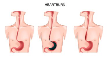 stomach, esophagus, heartburn clipart