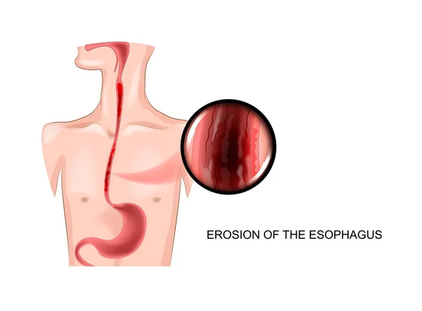 Erosion of the esophagus — Stock Vector