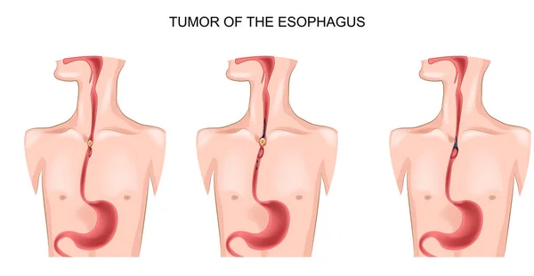 Tumor of the esophagus — Stock Vector