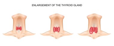 enlargement of the thyroid gland clipart