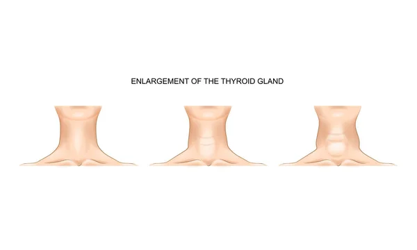 Leher dengan kelenjar tiroid yang membesar - Stok Vektor