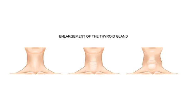 Hals med förstorad sköldkörtel — Stock vektor