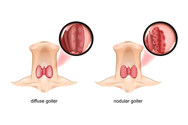 Bócio difuso e nodular, a glândula tireóide é uma visão seccional — Vetor de Stock