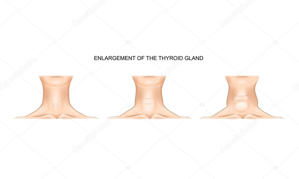 neck with enlarged thyroid gland