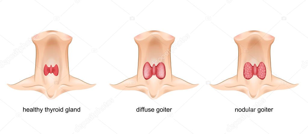 goiter, thyroid gland