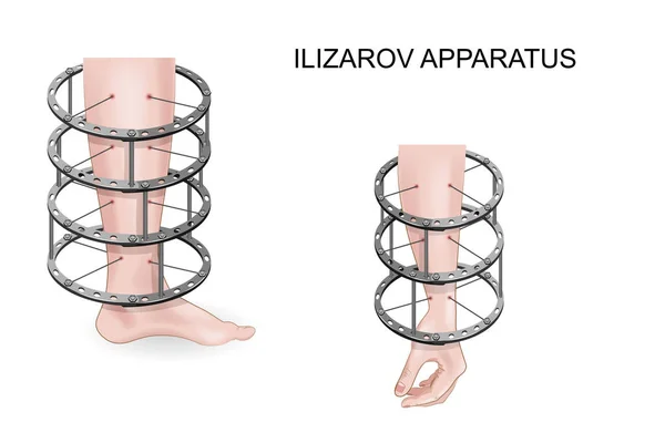 Ilizarov Apparat an Arm und Bein — Stockvektor