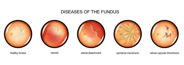 Inflamación del fondo, desprendimiento de retina — Vector de stock