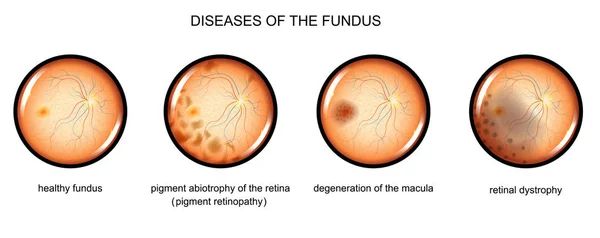 Enfermedades degenerativas del fondo — Vector de stock