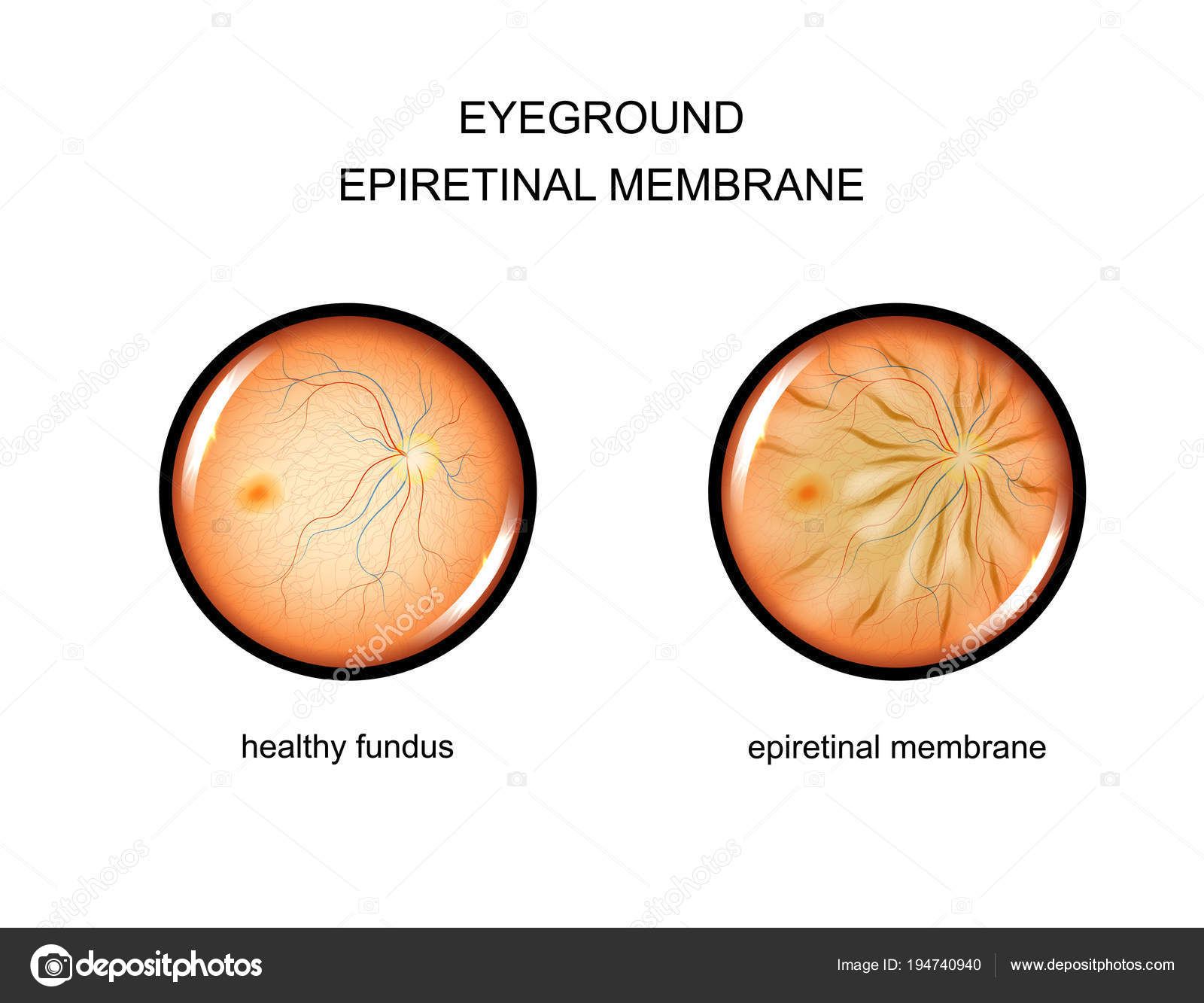 Fundus Epiretinal Membrane Vector Image By C Artemida Psy Vector Stock Fundus Epiretinal Membrane Vector Image By C Artemida Psy Vector Stock