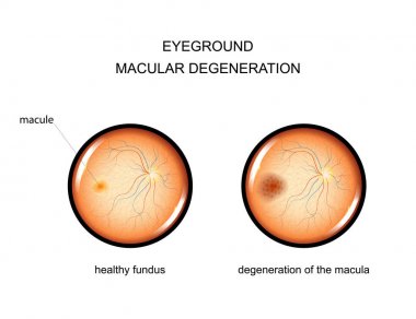 eyeground. Makula dejenerasyonu