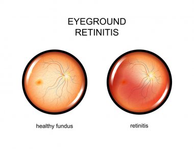 göz, fundus. Retinitis