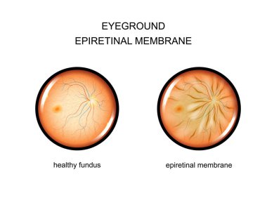Fundus. epiretinal membran