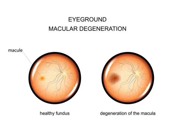 Eyeground. degeneration of the macula — Stock Vector