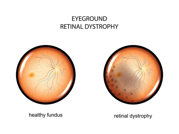Eyeground. retinale dystrofie — Stockvector