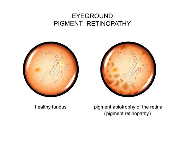 fundus. pigment retinopathy