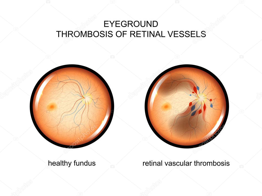 fundus. retinal vascular thrombosis