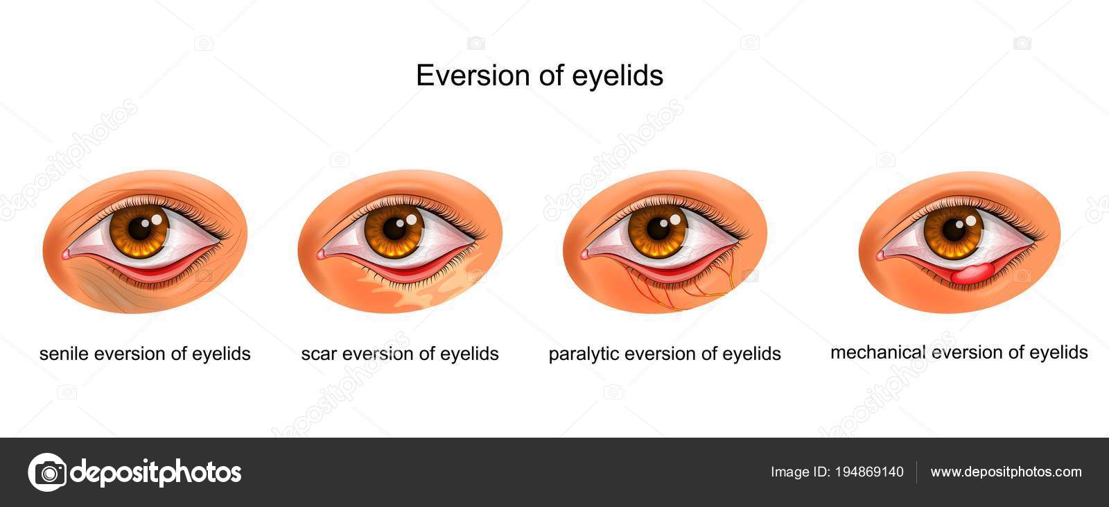 The causes of eversion of eyelids Stock Vector Image by ©Artemida-psy ...