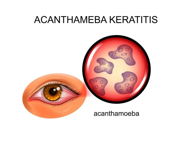 Akanthameba-Keratitis. Bindehautentzündung — Stockvektor