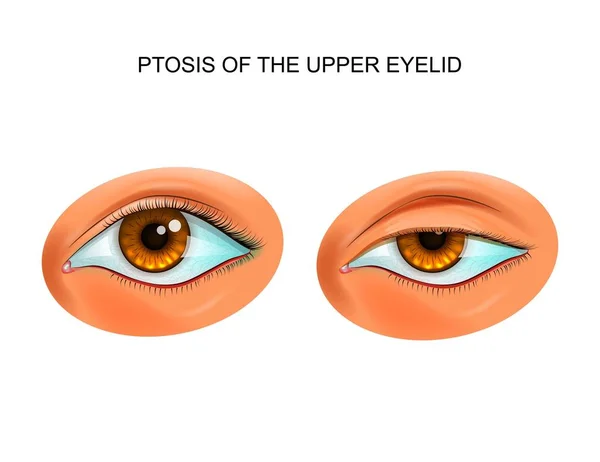 Ptosis del párpado — Vector de stock