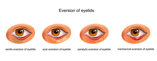 The causes of eversion of eyelids — Stock Vector