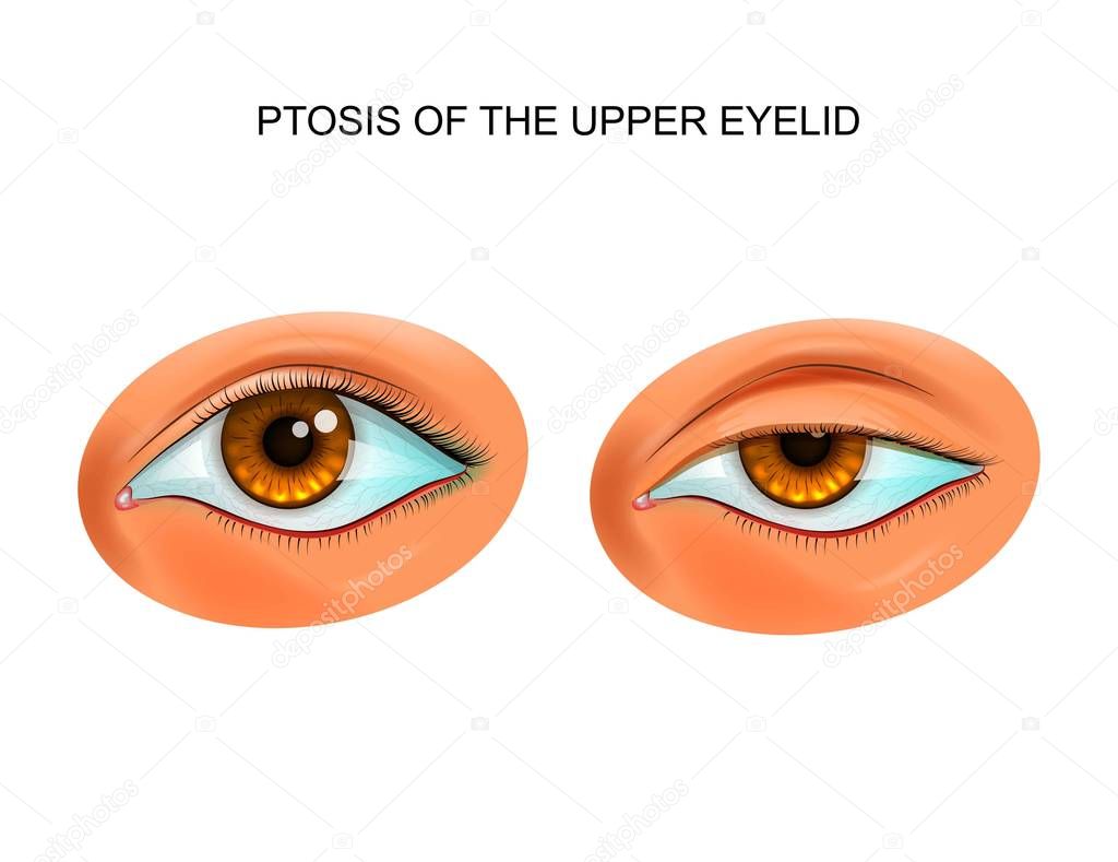 ptosis of the eyelid