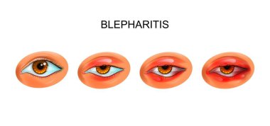 inflammation of the eyelids. blepharitis clipart