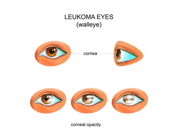 Глаза лейкомы. walleye — стоковый вектор
