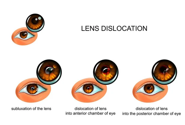 Vector Illustration Dislocated Lens Eye — Stock Vector