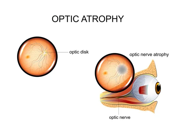 Ilustración Vectorial Atrofia Del Nervio Óptico Fondo Ojo — Archivo Imágenes Vectoriales