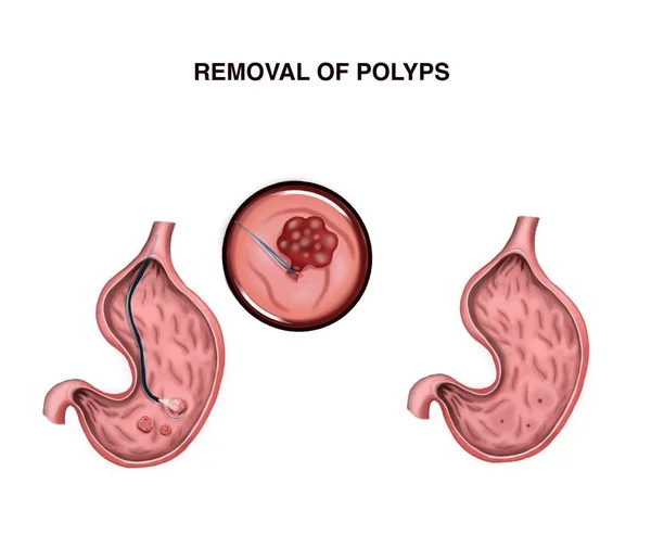 Illustration of removal of stomach polyps — Stock Image Illustration Removal Stomach Polyps Stock Image