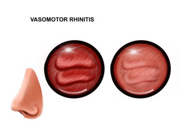 Burun mukozasının vazomotor rhinitis çizimi. sağlıklı ve iltihaplı