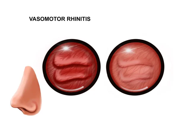 Ilustrace Vazomotorické Rýmy Nosní Sliznice Zdravý Zanícený — Stock fotografie