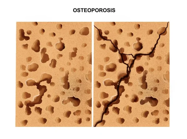 Illustratie Van Het Proces Van Osteoporose — Stockfoto