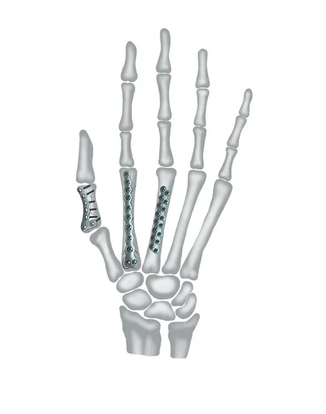 親指の骨折のイラスト 骨合成 — ストック写真