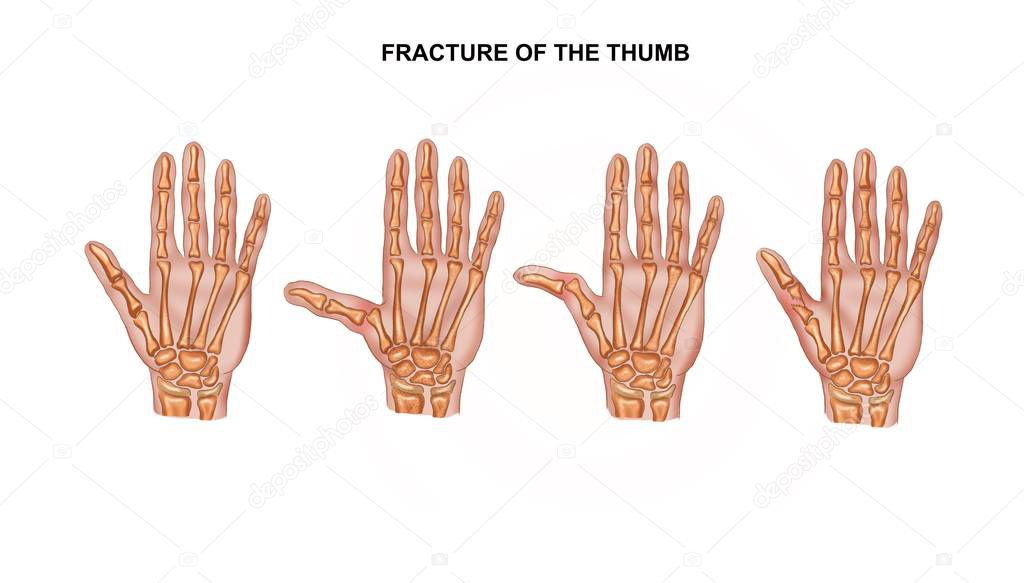 Illustration of the fracture of the thumb. osteosynthesis