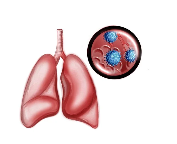 Ilustrasi Dari Patogen Dari Coronavirus — Stok Foto