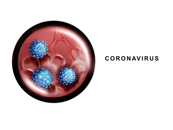 コロナウイルスの病原体のイラスト — ストック写真