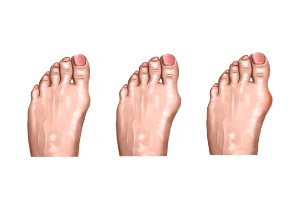 Ilustrace Poranění Nohy Při Artritidě — Stock fotografie