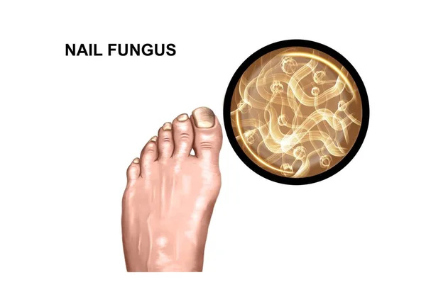 足の真菌病変のイラスト — ストック写真