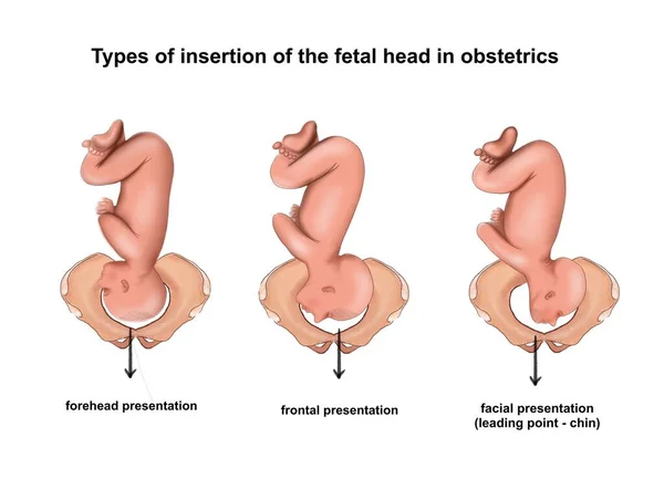 Ilustración Los Tipos Inserción Cabeza Fetal Obstetricia — Foto de Stock