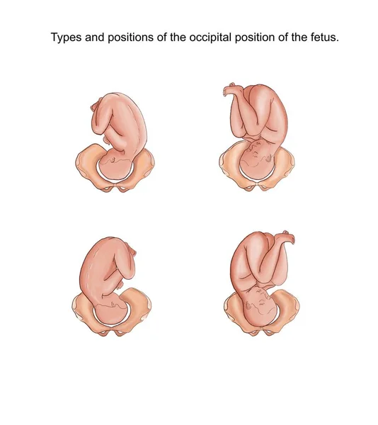 Illustration Der Typen Und Positionen Der Okzipitalen Position Des Fötus — Stockfoto