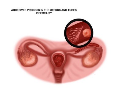 Illustration of the adhesive process in the uterus and tubes. Infertility clipart