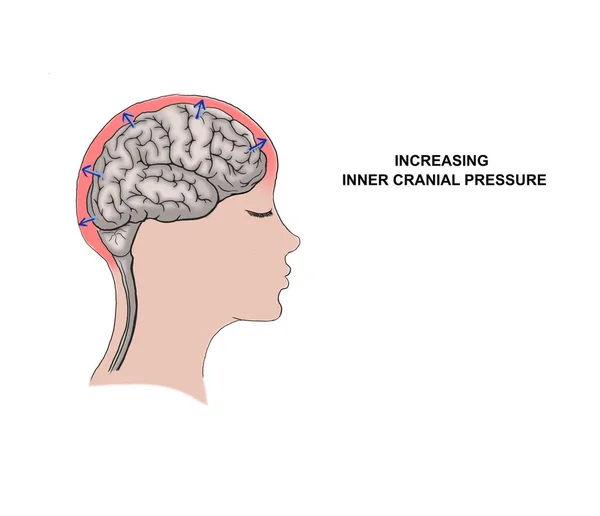 Illustratie Van Toenemende Innerlijke Craniale Druk — Stockfoto