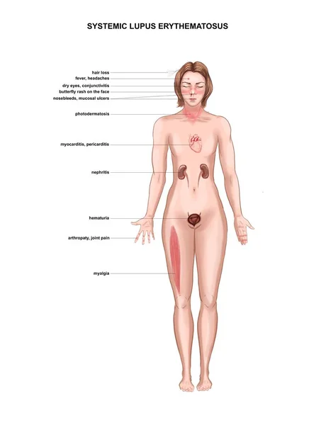 Ilustración Los Síntomas Del Lupus Eritematoso Sistémico — Foto de Stock