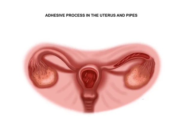 子宫和输卵管粘连过程的说明 不孕症 — 图库照片